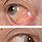 Conjunctival Granuloma Eye