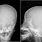 Craniosynostosis X-ray