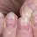 Dents in Fingernails