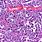 Diffuse Large B-cell Lymphoma