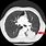 Early Lung Cancer CT Scan