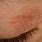 Eczema On My Eyelids