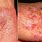 Eczema or Psoriasis