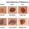 Examples of Melanoma Skin Cancer