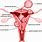 Fibroid Positions