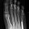 Foot Fracture 5th Metatarsal