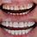 Front Teeth Veneers