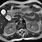 Gallbladder MRI Scan