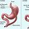 Gastric Weight Loss Surgery