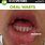 Genital Warts On Mouth