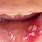 HPV Sores On Tongue