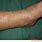 Hyperkeratotic Skin Lesion