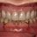 Implant Partial Denture
