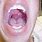 Infected Uvula