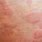 Itchy Red Skin Rash