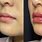 Korean Lip Filler