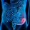 Large Intestine Colon Cancer