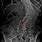 Lateral Listhesis Lumbar Spine