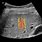 Liver Fibrosis On Ultrasound