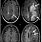 MRI Brain Scan MS
