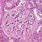 Membranous Glomerulonephritis