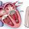 Mitral Heart Valve Replacement