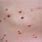 Molluscum Contagiosum Children