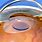 Multifocal Cataract Lens