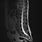 Normal MRI of Spine