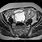 Ovarian Cancer On MRI