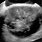 Ovarian Teratoma On Ultrasound