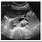 Pancreas Cyst Ultrasound