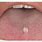 Papilloma Under Tongue