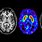 Parkinson's Brain MRI