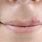 Pimple in Lip
