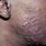 Pimples On Black Skin