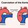 Preductal Coarctation of Aorta