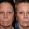 ProFractional Laser Before and After