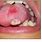 Pyogenic Granuloma On Tongue
