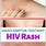 Rash Caused by HIV