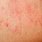 Rashes That Itch and Burn