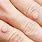 Skin Lesions On Fingers