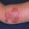 Skin Ulcer Dermatology