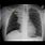 Small Cell Lung Cancer Chest X-Ray