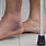 Sprained Ankle vs Broken Foot