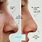 Surgery for Nose Bone Increase