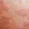 Symptom Itchy Skin Rash