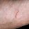 Symptoms of Scabies Rash