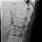 Thoracolumbar Spine X-Ray