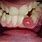 Tooth Tumor